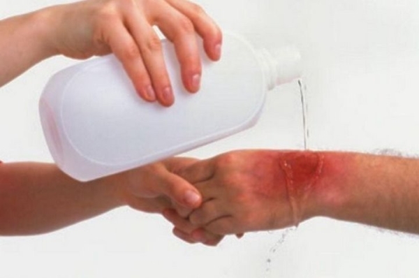 Как помочь при ожоге в домашних условиях? Житель Бреста интересуется