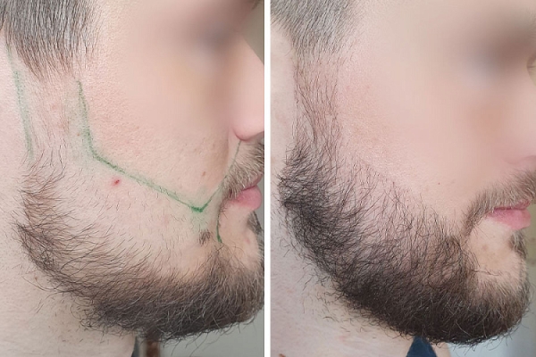 Как белорусы пересаживают волосы Как белорусы пересаживают волосы