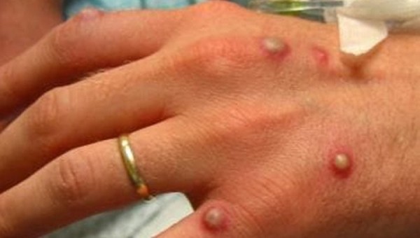 В Грузии выявили первый случай заражения оспой обезьян В Грузии выявили первый случай заражения оспой обезьян