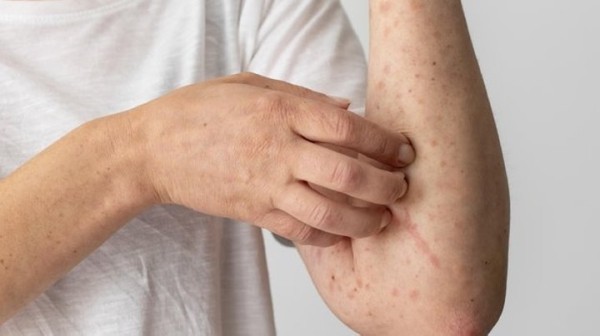 В Жабинковском районе зафиксирован случай заболевания корью В Жабинковском районе зафиксирован случай заболевания корью