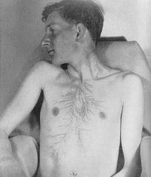 После разряда — что происходит с человеком, в которого ударила молния После разряда — что происходит с человеком, в которого ударила молния