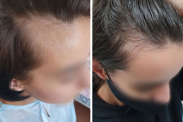 Как белорусы пересаживают волосы Как белорусы пересаживают волосы