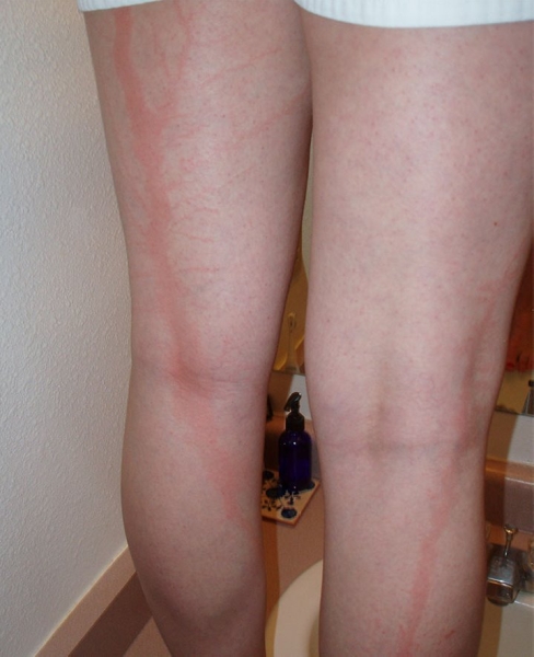 После разряда — что происходит с человеком, в которого ударила молния После разряда — что происходит с человеком, в которого ударила молния