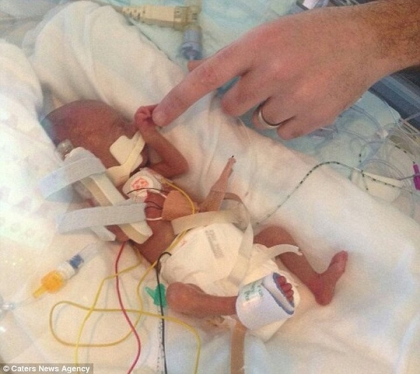 Удивительная история крошечной малышки, которая выжила несмотря ни на что Удивительная история крошечной малышки, которая выжила несмотря ни на что