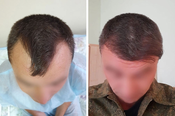 Как белорусы пересаживают волосы Как белорусы пересаживают волосы