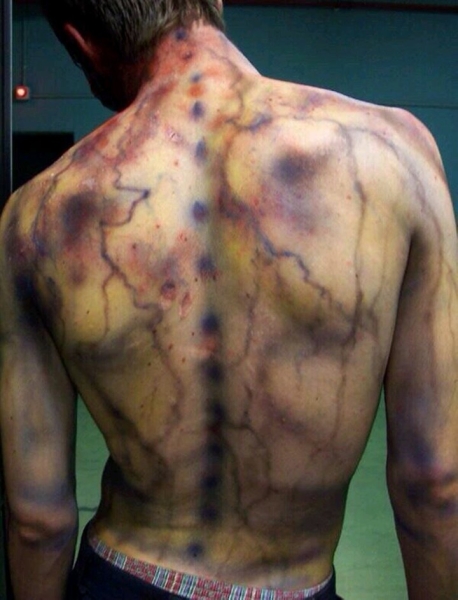 После разряда — что происходит с человеком, в которого ударила молния После разряда — что происходит с человеком, в которого ударила молния