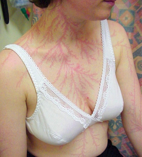 После разряда — что происходит с человеком, в которого ударила молния После разряда — что происходит с человеком, в которого ударила молния